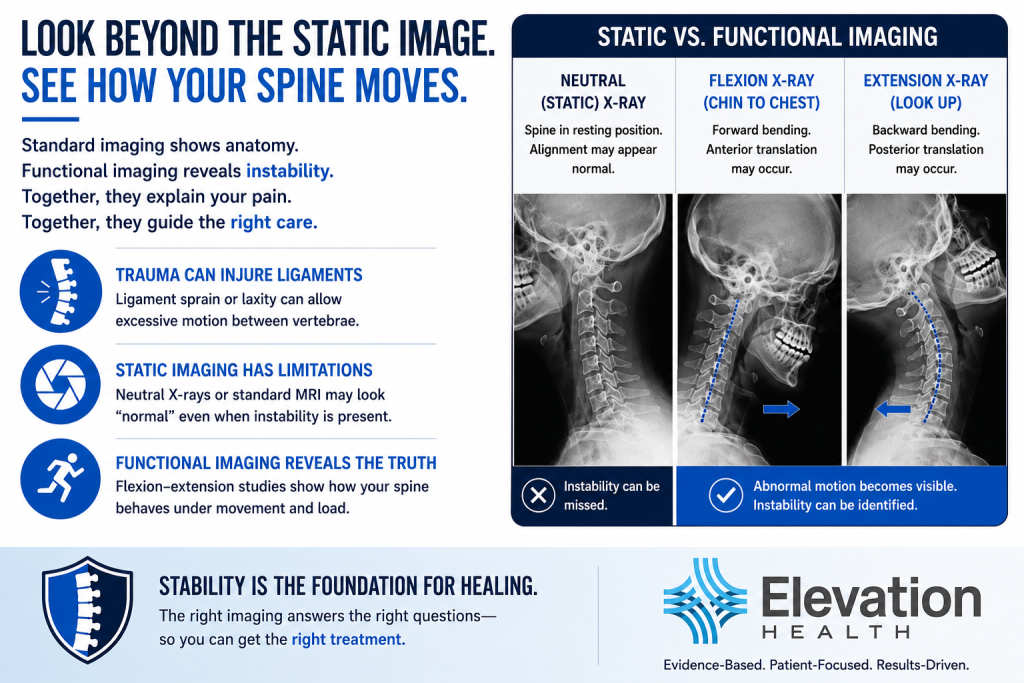 Flexion-extension X-rays showing how spinal instability after a car accident may be identified by abnormal vertebral motion.